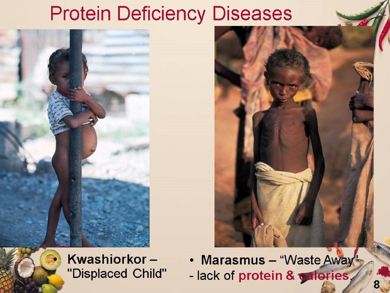 8 Protein Deficiency Diseases Kwashiorkor –        